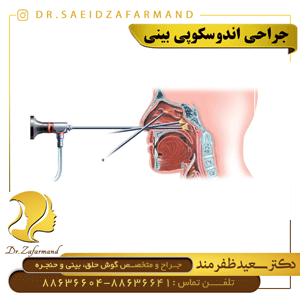 جراحی آندوسکوپی بینی