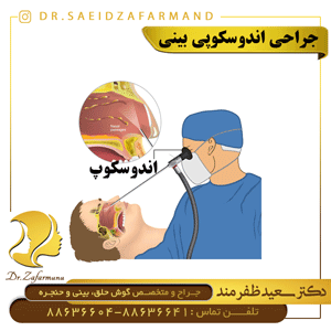جراحی آندوسکوپی بینی