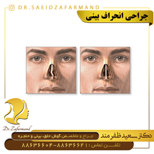جراحی انحراف بینی