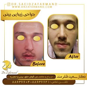 جراحی انحراف بینی