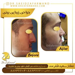 جراحی انحراف بینی