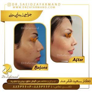 مراحل جراحی بینی