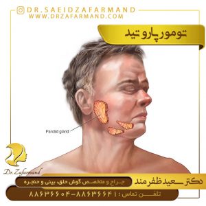تومور پاروتید