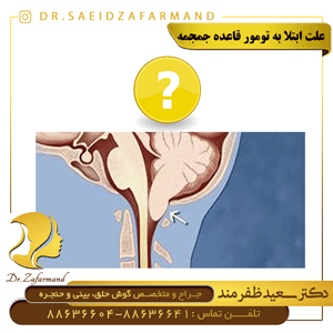 علت ابتلا به تومور قاعده جمجمه