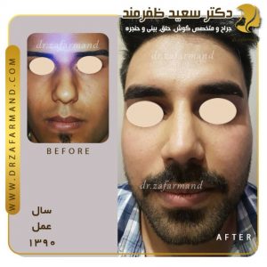 آیا زمان جراحی نوک بینی از یک رینوپلاستی کامل کمتر است؟