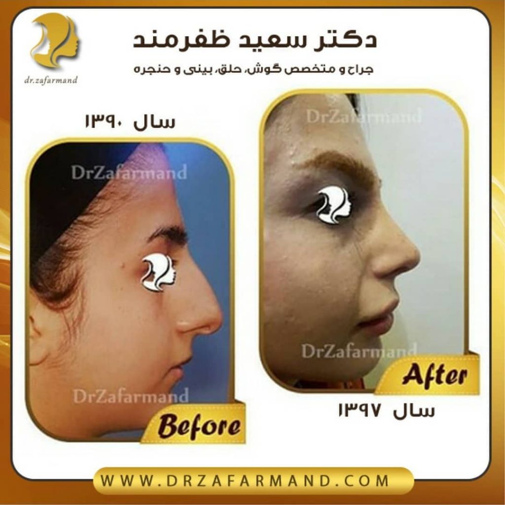 عکس قبل و بعد از جراحی بینی از راست