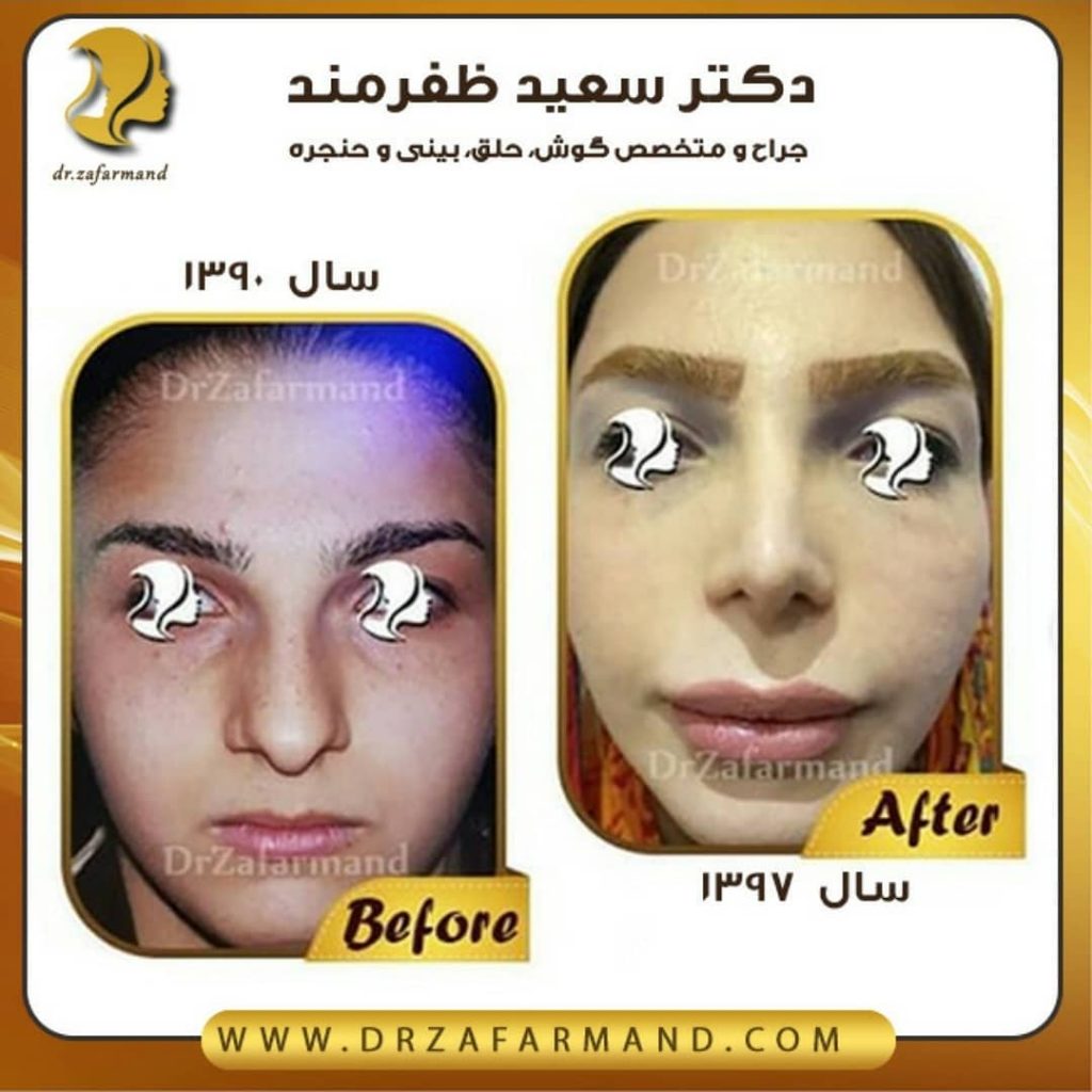 عکس قبل و بعد از جراحی بینی از روبرو