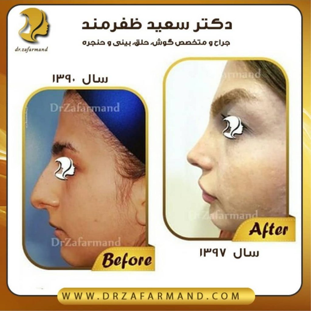 عکس قبل و بعد از جراحی بینی از چپ