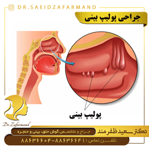 جراحی پولیپ بینی