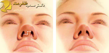 مراحل جراحی بینی چیست؟