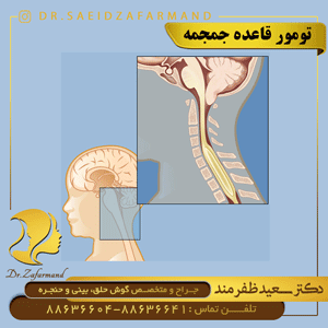 تومور قاعده جمجمه