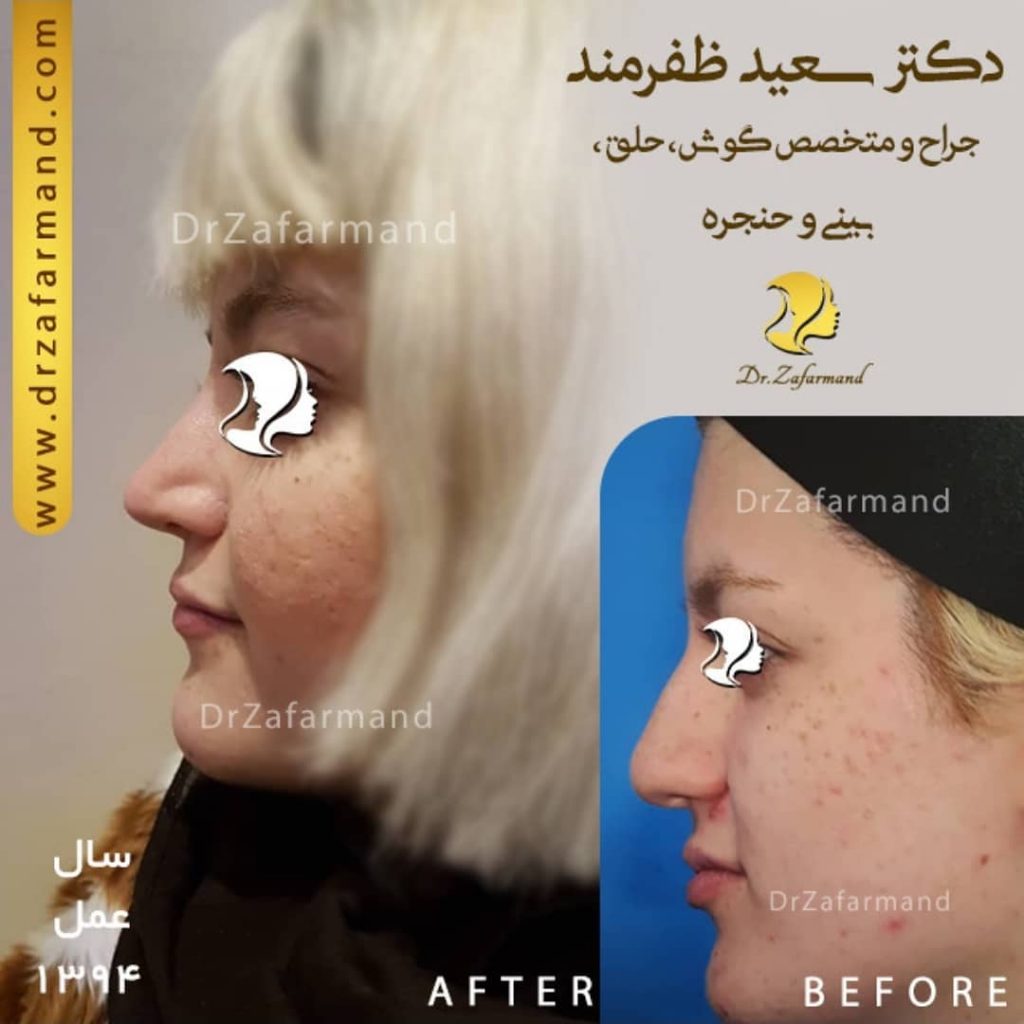 جراحی بینی فانتزی