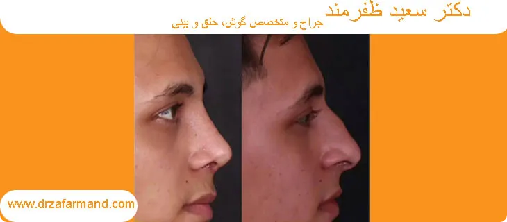 عمل قوز بینی