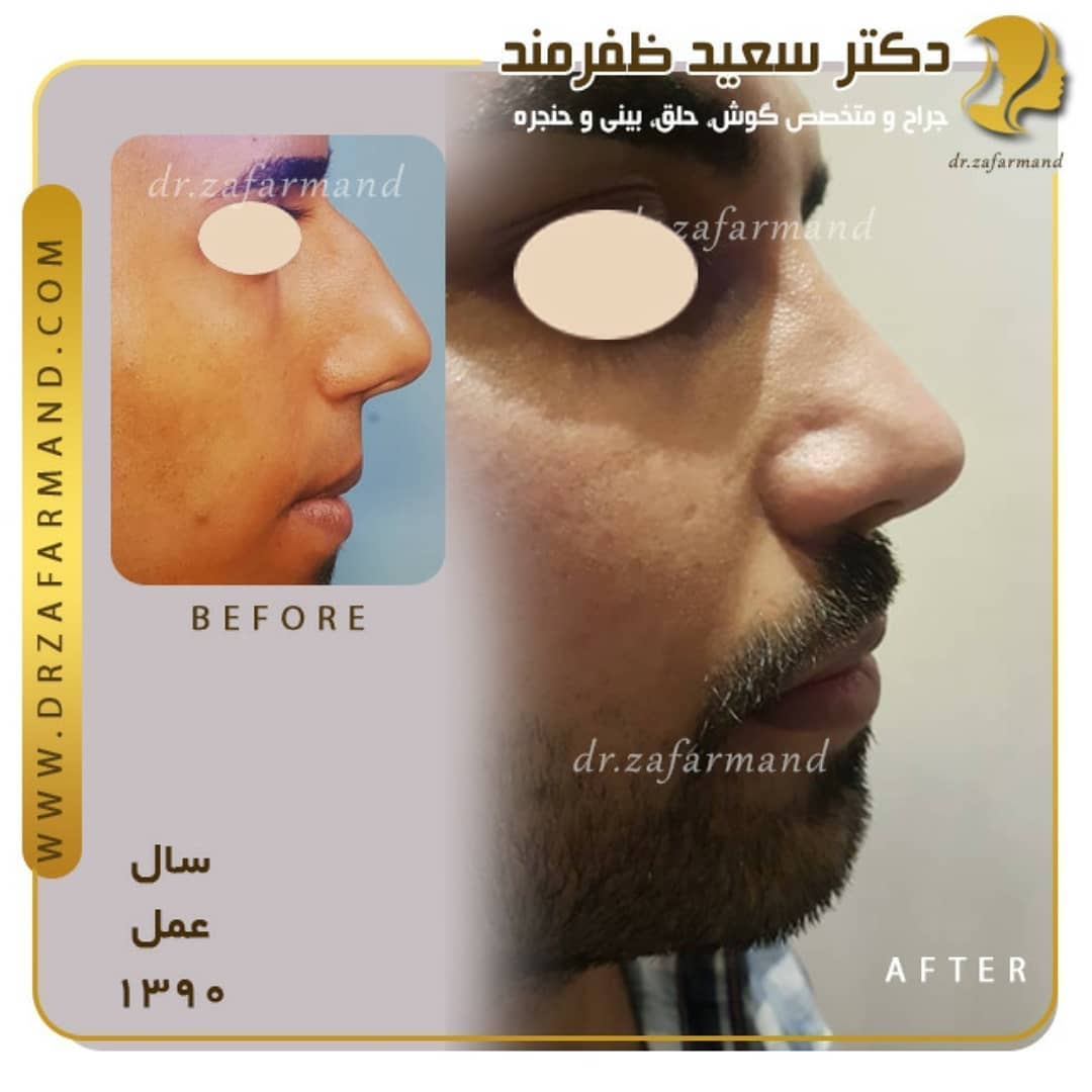 جراحی بینی گوشتی در مردان