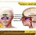 جراحی تومور سینوس