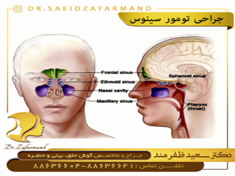 جراحی تومور سینوس