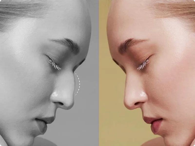 جراحی قوز بینی