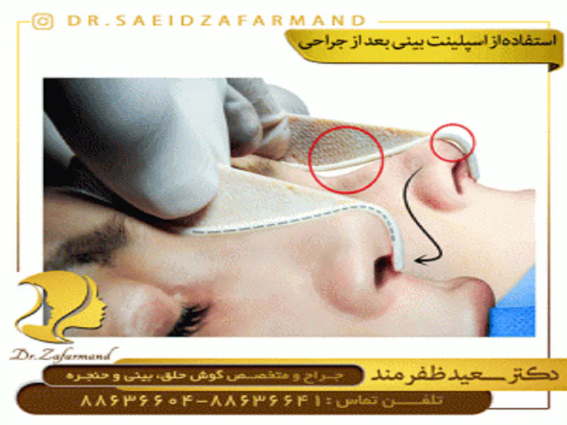 علت استفاده از اسپلینت بینی بعد از جراحی