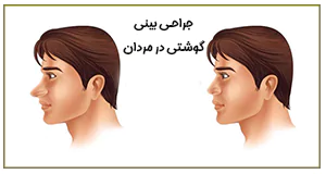عمل بینی گوشتی در مردان