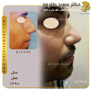 جراحی بینی گوشتی در مردان چگونه انجام می شود؟