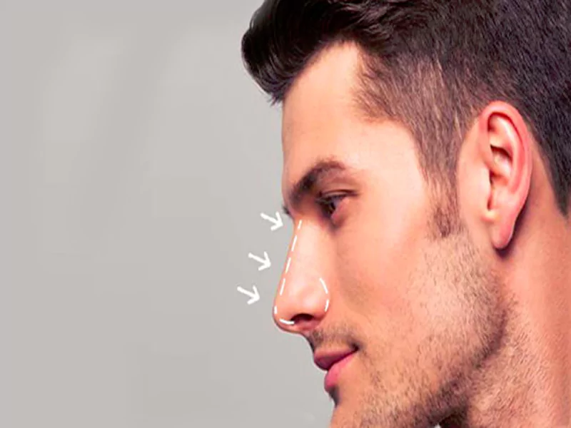 عمل بینی گوشتی در مردان
