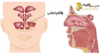 علائم پولیپ بینی