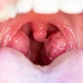 جراحی لوزه چگونه انجام می شود؟