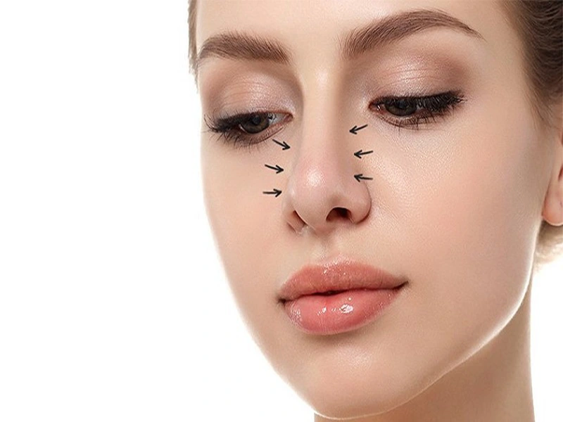 جراحی بینی گوشتی چگونه انجام می شود؟