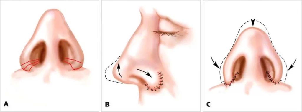 آلارپلاستی