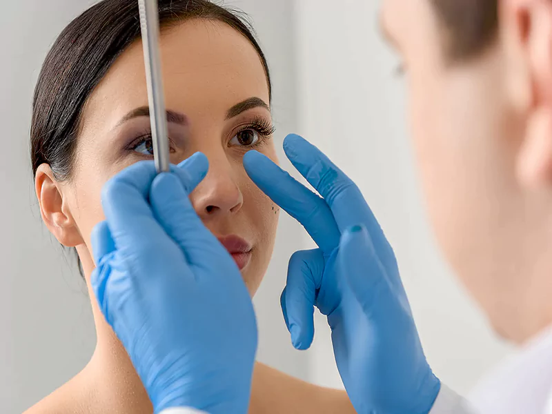 جراحی بینی به روش باز