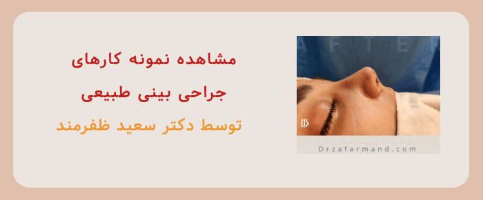 نمونه کار جراحی بینی 
