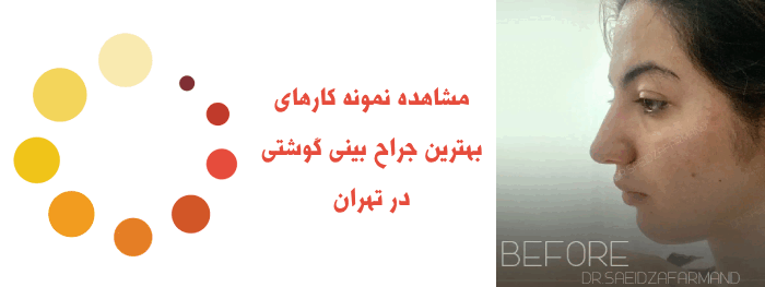 نمونه کار بهترین جراح بینی گوشتی در تهران