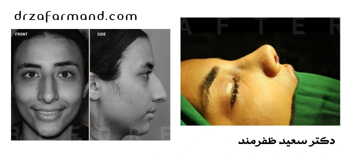 عکس بینی استخوانی عمل شده