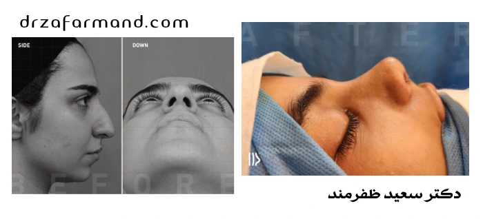 عکس قبل و بعد عمل بینی استخوانی