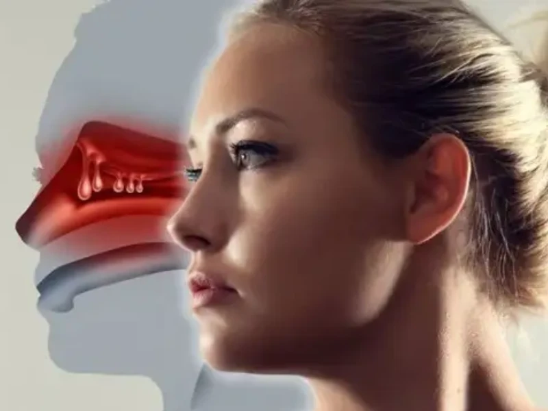 عمل پولیپ بینی همزمان با زیبایی