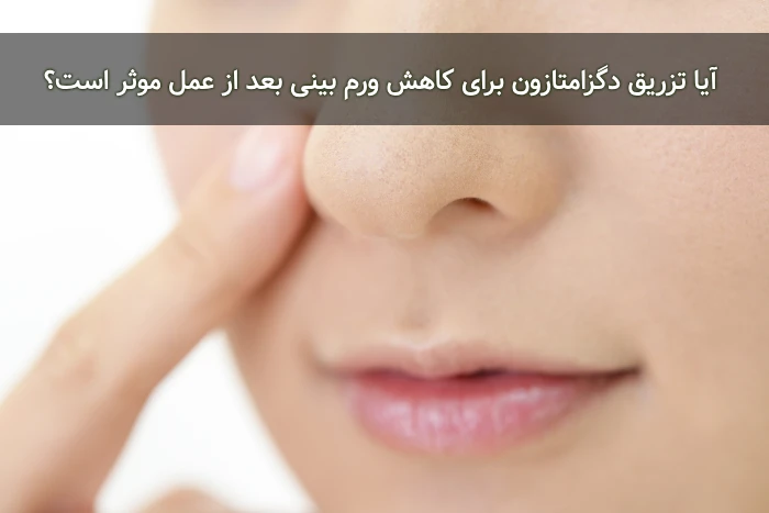 تزریق دگزامتازون بعد از عمل بینی