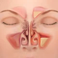 سینوزیت مزمن چیست