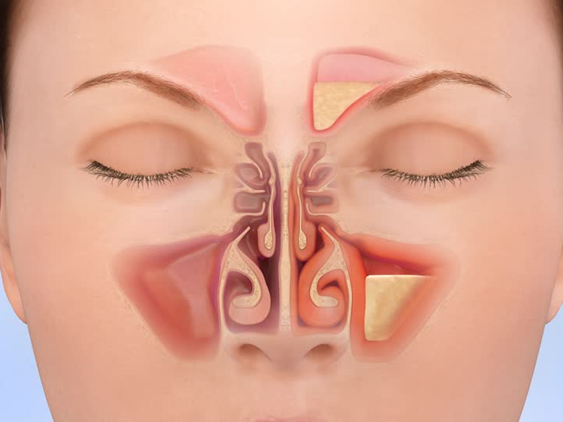 سینوزیت مزمن چیست