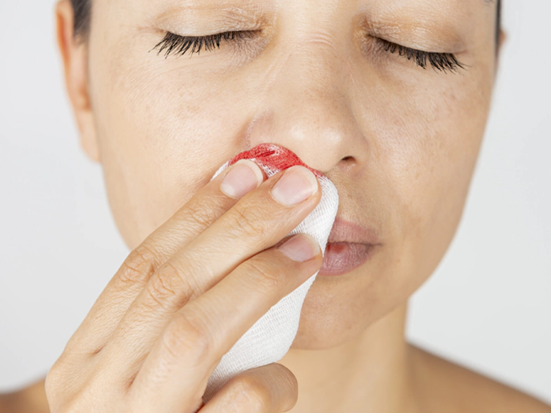 خونریزی بعد از عمل بینی